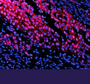 Immunofluorescent staining of TNFAIP2 using anti-TNFAIP2 antibody (red). TNFAIP2 was detected in a paraffin-embedded section of human bladder cancer tissue. Heat mediated antigen retrieval was performed in EDTA buffer (pH 8.0, epitope retrieval solution). The tissue section was blocked with 10% goat serum. The tissue section was then incubated with 5 ug/ml rabbit anti-TNFAIP2 antibody overnight at 4oC. Cy3 Conjugated Goat Anti-Rabbit IgG was used as secondary antibody at 1:500 dilution and incubated for 30 minutes at 37oC. The section was counterstained with DAPI nuclear stain (blue). Visualize using a fluorescence microscope and filter sets appropriate for the label used.