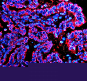 Immunofluorescent staining of P2RX1 using anti-P2RX1 antibody (red). P2RX1 was detected in a paraffin-embedded section of human lung cancer tissue. Heat mediated antigen retrieval was performed in EDTA buffer (pH 8.0, epitope retrieval solution). The tissue section was blocked with 10% goat serum. The tissue section was then incubated with 5 ug/ml rabbit anti-P2RX1 antibody overnight at 4oC. Cy3 Conjugated Goat Anti-Rabbit IgG was used as secondary antibody at 1:500 dilution and incubated for 30 minutes at 37oC. The section was counterstained with DAPI nuclear stain (blue). Visualize using a fluorescence microscope and filter sets appropriate for the label used.