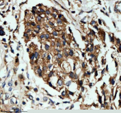 Immunohistochemical staining of NID1 using anti-NID1 antibody. NID1 was detected in a paraffin-embedded section of human breast cancer tissue. Heat mediated antigen retrieval was performed in EDTA buffer (pH 8.0, epitope retrieval solution). The tissue section was blocked with 10% goat serum. The tissue section was then incubated with 2 ug/ml rabbit anti-NID1 antibody overnight at 4oC. Peroxidase Conjugated Goat Anti-rabbit IgG was used as secondary antibody and incubated for 30 minutes at 37oC. The tissue section was developed using an HRP secondary and DAB substrate.