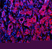 Immunofluorescent staining of NID1 using anti-NID1 antibody (red). NID1 was detected in a paraffin-embedded section of human breast cancer tissue. Heat mediated antigen retrieval was performed in EDTA buffer (pH 8.0, epitope retrieval solution). The tissue section was blocked with 10% goat serum. The tissue section was then incubated with 5 ug/ml rabbit anti-NID1 antibody overnight at 4oC. Cy3 Conjugated Goat Anti-Rabbit IgG was used as secondary antibody at 1:500 dilution and incubated for 30 minutes at 37oC. The section was counterstained with DAPI nuclear stain (blue). Visualize using a fluorescence microscope and filter sets appropriate for the label used.