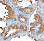 Immunohistochemical staining of RHOT2 using anti-RHOT2 antibody. RHOT2 was detected in a paraffin-embedded section of human cervical cancer tissue. Heat mediated antigen retrieval was performed in EDTA buffer (pH 8.0, epitope retrieval solution). The tissue section was blocked with 10% goat serum. The tissue section was then incubated with 2 ug/ml rabbit anti-RHOT2 antibody overnight at 4oC. Peroxidase Conjugated Goat Anti-rabbit IgG was used as secondary antibody and incubated for 30 minutes at 37oC. The tissue section was developed using an HRP secondary and DAB substrate.