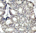 Immunohistochemical staining of PIK3CB using anti- PIK3CB antibody. PIK3CB was detected in a paraffin-embedded section of human colon cancer tissue. Heat mediated antigen retrieval was performed in EDTA buffer (pH 8.0, epitope retrieval solution). The tissue section was blocked with 10% goat serum. The tissue section was then incubated with 1: 50 rabbit anti- PIK3CB antibody overnight at 4oC. Peroxidase Conjugated Goat Anti-rabbit IgG was used as secondary antibody and incubated for 30 minutes at 37oC. The tissue section was developed using an HRP secondary and DAB substrate.