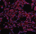 Immunofluorescent staining of MAML3 using anti-MAML3 antibody (red). MAML3 was detected in a paraffin-embedded section of human breast cancer tissue. Heat mediated antigen retrieval was performed in EDTA buffer (pH 8.0, epitope retrieval solution). The tissue section was blocked with 10% goat serum. The tissue section was then incubated with 5 ug/ml rabbit anti-MAML3 antibody overnight at 4oC. Cy3 Conjugated Goat Anti-Rabbit IgG was used as secondary antibody at 1:500 dilution and incubated for 30 minutes at 37oC. The section was counterstained with DAPI nuclear stain (blue). Visualize using a fluorescence microscope and filter sets appropriate for the label used.