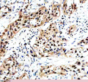 Immunohistochemical staining of MAML3 using anti-MAML3 antibody. MAML3 was detected in a paraffin-embedded section of human bladder cancer tissue. Heat mediated antigen retrieval was performed in EDTA buffer (pH 8.0, epitope retrieval solution). The tissue section was blocked with 10% goat serum. The tissue section was then incubated with 2 ug/ml rabbit anti-MAML3 antibody overnight at 4oC. Peroxidase Conjugated Goat Anti-rabbit IgG was used as secondary antibody and incubated for 30 minutes at 37oC. The tissue section was developed using an HRP secondary and DAB substrate.
