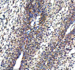 Immunohistochemical staining of NDUFS3 using anti-NDUFS3 antibody. NDUFS3 was detected in a paraffin-embedded section of human ovarian cancer tissue. Heat mediated antigen retrieval was performed in EDTA buffer (pH 8.0, epitope retrieval solution). The tissue section was blocked with 10% goat serum. The tissue section was then incubated with 2 ug/ml rabbit anti-NDUFS3 antibody overnight at 4oC. Peroxidase Conjugated Goat Anti-rabbit IgG was used as secondary antibody and incubated for 30 minutes at 37oC. The tissue section was developed using an HRP secondary and DAB substrate.