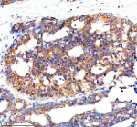 Immunohistochemical staining of NCR3LG1 using anti-NCR3LG1 antibody. NCR3LG1 was detected in a paraffin-embedded section of human breast cancer tissue. Heat mediated antigen retrieval was performed in EDTA buffer (pH 8.0, epitope retrieval solution). The tissue section was blocked with 10% goat serum. The tissue section was then incubated with 2 ug/ml rabbit anti-NCR3LG1 antibody overnight at 4oC. Peroxidase Conjugated Goat Anti-rabbit IgG was used as secondary antibody and incubated for 30 minutes at 37oC. The tissue section was developed using an HRP secondary and DAB substrate.