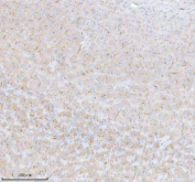 Immunohistochemical staining of STRBP using anti-STRBP antibody. STRBP was detected in a paraffin-embedded section of human ovarian cancer tissue. Heat mediated antigen retrieval was performed in EDTA buffer (pH 8.0, epitope retrieval solution). The tissue section was blocked with 10% goat serum. The tissue section was then incubated with 2 ug/ml rabbit anti-STRBP antibody overnight at 4oC. Peroxidase Conjugated Goat Anti-rabbit IgG was used as secondary antibody and incubated for 30 minutes at 37oC. The tissue section was developed using an HRP secondary and DAB substrate.