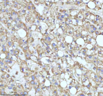 Immunohistochemical staining of MALSU1 using anti-MALSU1 antibody. MALSU1 was detected in a paraffin-embedded section of human liver cancer tissue. Heat mediated antigen retrieval was performed in EDTA buffer (pH 8.0, epitope retrieval solution). The tissue section was blocked with 10% goat serum. The tissue section was then incubated with 2 ug/ml rabbit anti-MALSU1 antibody overnight at 4oC. Peroxidase Conjugated Goat Anti-rabbit IgG was used as secondary antibody and incubated for 30 minutes at 37oC. The tissue section was developed using an HRP secondary and DAB substrate.