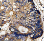Immunohistochemical staining of MST4/STK26 using anti-STK26 antibody. MST4/STK26 was detected in a paraffin-embedded section of human colon cancer tissue. Heat mediated antigen retrieval was performed in EDTA buffer (pH 8.0, epitope retrieval solution). The tissue section was blocked with 10% goat serum. The tissue section was then incubated with 1: 50 rabbit anti-STK26 antibody overnight at 4oC. Peroxidase Conjugated Goat Anti-rabbit IgG was used as secondary antibody and incubated for 30 minutes at 37oC. The tissue section was developed using an HRP secondary and DAB substrate.