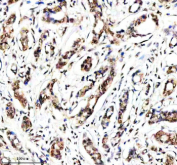 Immunohistochemical staining of Histone H4 using anti-Histone H4 antibody. Histone H4 was detected in a paraffin-embedded section of human breast cancer tissue. Heat mediated antigen retrieval was performed in EDTA buffer (pH 8.0, epitope retrieval solution). The tissue section was blocked with 10% goat serum. The tissue section was then incubated with 2 ug/ml rabbit anti-Histone H4 antibody overnight at 4oC. Peroxidase Conjugated Goat Anti-rabbit IgG was used as secondary antibody and incubated for 30 minutes at 37oC. The tissue section was developed using an HRP secondary and DAB substrate.