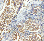 Immunohistochemical staining of BCAP29 using anti-BCAP29 antibody. BCAP29 was detected in a paraffin-embedded section of human lung adenocarcinoma tissue. Heat mediated antigen retrieval was performed in EDTA buffer (pH 8.0, epitope retrieval solution). The tissue section was blocked with 10% goat serum. The tissue section was then incubated with 2 ug/ml rabbit anti-BCAP29 antibody overnight at 4oC. Peroxidase Conjugated Goat Anti-rabbit IgG was used as secondary antibody and incubated for 30 minutes at 37oC. The tissue section was developed using an HRP secondary and DAB substrate.
