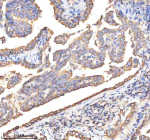Immunohistochemical staining of BCAP31 using anti-BCAP31 antibody. BCAP31 was detected in a paraffin-embedded section of human lung adenocarcinoma tissue. Heat mediated antigen retrieval was performed in EDTA buffer (pH 8.0, epitope retrieval solution). The tissue section was blocked with 10% goat serum. The tissue section was then incubated with 2 ug/ml rabbit anti-BCAP31 antibody overnight at 4oC. Peroxidase Conjugated Goat Anti-rabbit IgG was used as secondary antibody and incubated for 30 minutes at 37oC. The tissue section was developed using an HRP secondary and DAB substrate.