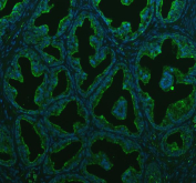 Immunofluorescent staining of BCAP31 using anti-BCAP31 antibody (green). BCAP31 was detected in a paraffin-embedded section of human prostate cancer tissue. Heat mediated antigen retrieval was performed in EDTA buffer (pH 8.0, epitope retrieval solution). The tissue section was blocked with 10% goat serum. The tissue section was then incubated with 5 ug/ml rabbit anti-BCAP31 antibody overnight at 4oC. DyLight 488 Conjugated Goat Anti-Rabbit IgG was used as secondary antibody at 1:500 dilution and incubated for 30 minutes at 37oC. The section was counterstained with DAPI nuclear stain (blue). Visualize using a fluorescence microscope and filter sets appropriate for the label used.