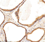 Immunohistochemical staining of BCAP31 using anti-BCAP31 antibody. BCAP31 was detected in a paraffin-embedded section of human thyroid cancer tissue. Heat mediated antigen retrieval was performed in EDTA buffer (pH 8.0, epitope retrieval solution). The tissue section was blocked with 10% goat serum. The tissue section was then incubated with 2 ug/ml rabbit anti-BCAP31 antibody overnight at 4oC. Peroxidase Conjugated Goat Anti-rabbit IgG was used as secondary antibody and incubated for 30 minutes at 37oC. The tissue section was developed using an HRP secondary and DAB substrate.