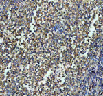 Immunohistochemical staining of ITGB7 using anti-ITGB7 antibody. ITGB7 was detected in a paraffin-embedded section of human lymphoma tissue. Heat mediated antigen retrieval was performed in EDTA buffer (pH 8.0, epitope retrieval solution). The tissue section was blocked with 10% goat serum. The tissue section was then incubated with 1:50 rabbit anti-ITGB7 antibody overnight at 4oC. Peroxidase Conjugated Goat Anti-rabbit IgG was used as secondary antibody and incubated for 30 minutes at 37oC. The tissue section was developed using an HRP secondary and DAB substrate.
