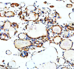 Immunohistochemical staining of MSI2 using anti-MSI2 antibody. MSI2 was detected in a paraffin-embedded section of human thyroid cancer tissue. Heat mediated antigen retrieval was performed in EDTA buffer (pH 8.0, epitope retrieval solution). The tissue section was blocked with 10% goat serum. The tissue section was then incubated with 2 ug/ml rabbit anti-MSI2 antibody overnight at 4oC. Peroxidase Conjugated Goat Anti-rabbit IgG was used as secondary antibody and incubated for 30 minutes at 37oC. The tissue section was developed using an HRP secondary and DAB substrate.