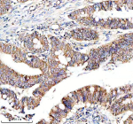 Immunohistochemical staining of NDUF-S2 using anti-NDUF-S2 antibody. NDUF-S2 was detected in a paraffin-embedded section of human colon cancer tissue. Heat mediated antigen retrieval was performed in EDTA buffer (pH 8.0, epitope retrieval solution). The tissue section was blocked with 10% goat serum. The tissue section was then incubated with 1:50 rabbit anti-NDUF-S2 antibody overnight at 4oC. Peroxidase Conjugated Goat Anti-rabbit IgG was used as secondary antibody and incubated for 30 minutes at 37oC. The tissue section was developed using an HRP secondary and DAB substrate.