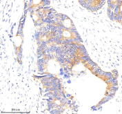 Immunohistochemical staining of ABR using anti-ABR antibody. ABR was detected in a paraffin-embedded section of human colon cancer tissue. Heat mediated antigen retrieval was performed in EDTA buffer (pH 8.0, epitope retrieval solution). The tissue section was blocked with 10% goat serum. The tissue section was then incubated with 2 ug/ml rabbit anti-ABR antibody overnight at 4oC. Peroxidase Conjugated Goat Anti-rabbit IgG was used as secondary antibody and incubated for 30 minutes at 37oC. The tissue section was developed using an HRP secondary and DAB substrate.