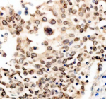 Immunohistochemical staining of TMPO using anti-TMPO antibody. TMPO was detected in a paraffin-embedded section of human lung cancer tissue. Heat mediated antigen retrieval was performed in EDTA buffer (pH 8.0, epitope retrieval solution). The tissue section was blocked with 10% goat serum. The tissue section was then incubated with 2 ug/ml rabbit anti-TMPO antibody overnight at 4oC. Peroxidase Conjugated Goat Anti-rabbit IgG was used as secondary antibody and incubated for 30 minutes at 37oC. The tissue section was developed using an HRP secondary and DAB substrate.