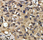 Immunohistochemical staining of QKI using anti-QKI antibody. QKI was detected in a paraffin-embedded section of human breast cancer tissue. Heat mediated antigen retrieval was performed in EDTA buffer (pH 8.0, epitope retrieval solution). The tissue section was blocked with 10% goat serum. The tissue section was then incubated with 2 ug/ml rabbit anti-QKI antibody overnight at 4oC. Peroxidase Conjugated Goat Anti-rabbit IgG was used as secondary antibody and incubated for 30 minutes at 37oC. The tissue section was developed using an HRP secondary and DAB substrate.