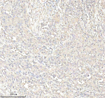 Immunohistochemical staining of Annexin using anti-Annexin antibody. Annexin was detected in a paraffin-embedded section of human bladder cancer tissue. Heat mediated antigen retrieval was performed in EDTA buffer (pH 8.0, epitope retrieval solution). The tissue section was blocked with 10% goat serum. The tissue section was then incubated with 2 ug/ml rabbit anti-Annexin antibody overnight at 4oC. Peroxidase Conjugated Goat Anti-rabbit IgG was used as secondary antibody and incubated for 30 minutes at 37oC. The tissue section was developed using an HRP secondary and DAB substrate.