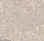 Immunohistochemical staining of Annexin using anti-Annexin antibody. Annexin was detected in a paraffin-embedded section of human liver cancer tissue. Heat mediated antigen retrieval was performed in EDTA buffer (pH 8.0, epitope retrieval solution). The tissue section was blocked with 10% goat serum. The tissue section was then incubated with 2 ug/ml rabbit anti-Annexin antibody overnight at 4oC. Peroxidase Conjugated Goat Anti-rabbit IgG was used as secondary antibody and incubated for 30 minutes at 37oC. The tissue section was developed using an HRP secondary and DAB substrate.