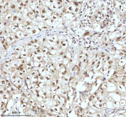 Immunohistochemical staining of IRF2BP1 using anti-IRF2BP1 antibody. IRF2BP1 was detected in a paraffin-embedded section of human acinic cell carcinoma of parotid cancer tissue. Heat mediated antigen retrieval was performed in EDTA buffer (pH 8.0, epitope retrieval solution). The tissue section was blocked with 10% goat serum. The tissue section was then incubated with 2 ug/ml rabbit anti-IRF2BP1 antibody overnight at 4oC. Peroxidase Conjugated Goat Anti-rabbit IgG was used as secondary antibody and incubated for 30 minutes at 37oC. The tissue section was developed using an HRP secondary and DAB substrate.