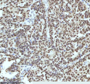 Immunohistochemical staining of IRF2BP1 using anti-IRF2BP1 antibody. IRF2BP1 was detected in a paraffin-embedded section of human ovarian cancer tissue. Heat mediated antigen retrieval was performed in EDTA buffer (pH 8.0, epitope retrieval solution). The tissue section was blocked with 10% goat serum. The tissue section was then incubated with 2 ug/ml rabbit anti-IRF2BP1 antibody overnight at 4oC. Peroxidase Conjugated Goat Anti-rabbit IgG was used as secondary antibody and incubated for 30 minutes at 37oC. The tissue section was developed using an HRP secondary and DAB substrate.