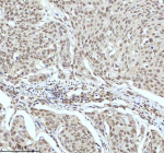 Immunohistochemical staining of IRF2BP1 using anti-IRF2BP1 antibody. IRF2BP1 was detected in a paraffin-embedded section of human cervical cancer tissue. Heat mediated antigen retrieval was performed in EDTA buffer (pH 8.0, epitope retrieval solution). The tissue section was blocked with 10% goat serum. The tissue section was then incubated with 2 ug/ml rabbit anti-IRF2BP1 antibody overnight at 4oC. Peroxidase Conjugated Goat Anti-rabbit IgG was used as secondary antibody and incubated for 30 minutes at 37oC. The tissue section was developed using an HRP secondary and DAB substrate.