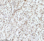 Immunohistochemical staining of IRF2BP1 using anti-IRF2BP1 antibody. IRF2BP1 was detected in a paraffin-embedded section of human clear cell renal carcinoma tissue. Heat mediated antigen retrieval was performed in EDTA buffer (pH 8.0, epitope retrieval solution). The tissue section was blocked with 10% goat serum. The tissue section was then incubated with 2 ug/ml rabbit anti-IRF2BP1 antibody overnight at 4oC. Peroxidase Conjugated Goat Anti-rabbit IgG was used as secondary antibody and incubated for 30 minutes at 37oC. The tissue section was developed using an HRP secondary and DAB substrate.