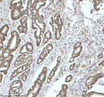 Immunohistochemical staining of IRF2BP1 using anti-IRF2BP1 antibody. IRF2BP1 was detected in a paraffin-embedded section of human colon adenocarcinoma tissue. Heat mediated antigen retrieval was performed in EDTA buffer (pH 8.0, epitope retrieval solution). The tissue section was blocked with 10% goat serum. The tissue section was then incubated with 2 ug/ml rabbit anti-IRF2BP1 antibody overnight at 4oC. Peroxidase Conjugated Goat Anti-rabbit IgG was used as secondary antibody and incubated for 30 minutes at 37oC. The tissue section was developed using an HRP secondary and DAB substrate.