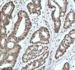 Immunohistochemical staining of IRF2BP1 using anti-IRF2BP1 antibody. IRF2BP1 was detected in a paraffin-embedded section of human colon adenocarcinoma tissue. Heat mediated antigen retrieval was performed in EDTA buffer (pH 8.0, epitope retrieval solution). The tissue section was blocked with 10% goat serum. The tissue section was then incubated with 2 ug/ml rabbit anti-IRF2BP1 antibody overnight at 4oC. Peroxidase Conjugated Goat Anti-rabbit IgG was used as secondary antibody and incubated for 30 minutes at 37oC. The tissue section was developed using an HRP secondary and DAB substrate.