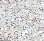 Immunohistochemical staining of IRF2BP1 using anti-IRF2BP1 antibody. IRF2BP1 was detected in a paraffin-embedded section of human liver cancer tissue. Heat mediated antigen retrieval was performed in EDTA buffer (pH 8.0, epitope retrieval solution). The tissue section was blocked with 10% goat serum. The tissue section was then incubated with 2 ug/ml rabbit anti-IRF2BP1 antibody overnight at 4oC. Peroxidase Conjugated Goat Anti-rabbit IgG was used as secondary antibody and incubated for 30 minutes at 37oC. The tissue section was developed using an HRP secondary and DAB substrate.