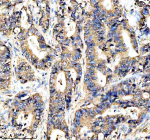 Immunohistochemical staining of APOBEC3C using anti-APOBEC3C antibody. APOBEC3C was detected in a paraffin-embedded section of human stomach cancer tissue. Heat mediated antigen retrieval was performed in EDTA buffer (pH 8.0, epitope retrieval solution). The tissue section was blocked with 10% goat serum. The tissue section was then incubated with 2 ug/ml rabbit anti-APOBEC3C antibody overnight at 4oC. Peroxidase Conjugated Goat Anti-rabbit IgG was used as secondary antibody and incubated for 30 minutes at 37oC. The tissue section was developed using an HRP secondary and DAB substrate.