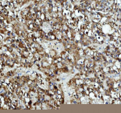 Immunohistochemical staining of DCTPP1 using anti-DCTPP1 antibody. DCTPP1 was detected in a paraffin-embedded section of human liver cancer tissue. Heat mediated antigen retrieval was performed in EDTA buffer (pH 8.0, epitope retrieval solution). The tissue section was blocked with 10% goat serum. The tissue section was then incubated with 2 ug/ml rabbit anti-DCTPP1 antibody overnight at 4oC. Peroxidase Conjugated Goat Anti-rabbit IgG was used as secondary antibody and incubated for 30 minutes at 37oC. The tissue section was developed using an HRP secondary and DAB substrate.