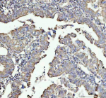 Immunohistochemical staining of NDUFAB1 using anti-NDUFAB1 antibody. NDUFAB1 was detected in a paraffin-embedded section of human colorectal adenocarcinoma tissue. Heat mediated antigen retrieval was performed in EDTA buffer (pH 8.0, epitope retrieval solution). The tissue section was blocked with 10% goat serum. The tissue section was then incubated with 1:50 rabbit anti-NDUFAB1 antibody overnight at 4oC. Peroxidase Conjugated Goat Anti-rabbit IgG was used as secondary antibody and incubated for 30 minutes at 37oC. The tissue section was developed using an HRP secondary and DAB substrate.