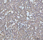 Immunohistochemical staining of NDUFAB1 using anti-NDUFAB1 antibody. NDUFAB1 was detected in a paraffin-embedded section of human breast cancer tissue. Heat mediated antigen retrieval was performed in EDTA buffer (pH 8.0, epitope retrieval solution). The tissue section was blocked with 10% goat serum. The tissue section was then incubated with 1:50 rabbit anti-NDUFAB1 antibody overnight at 4oC. Peroxidase Conjugated Goat Anti-rabbit IgG was used as secondary antibody and incubated for 30 minutes at 37oC. The tissue section was developed using an HRP secondary and DAB substrate.