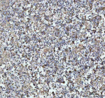 Immunohistochemical staining of NDUFAB1 using anti-NDUFAB1 antibody. NDUFAB1 was detected in a paraffin-embedded section of human testicular germ cell tumor tissue. Heat mediated antigen retrieval was performed in EDTA buffer (pH 8.0, epitope retrieval solution). The tissue section was blocked with 10% goat serum. The tissue section was then incubated with 1:50 rabbit anti-NDUFAB1 antibody overnight at 4oC. Peroxidase Conjugated Goat Anti-rabbit IgG was used as secondary antibody and incubated for 30 minutes at 37oC. The tissue section was developed using an HRP secondary and DAB substrate.