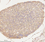 Immunohistochemical staining of ARHGEF7 using anti-ARHGEF7 antibody. ARHGEF7 was detected in a paraffin-embedded section of human liver cancer tissue. Heat mediated antigen retrieval was performed in EDTA buffer (pH 8.0, epitope retrieval solution). The tissue section was blocked with 10% goat serum. The tissue section was then incubated with 2 ug/ml rabbit anti-ARHGEF7 antibody overnight at 4oC. Peroxidase Conjugated Goat Anti-rabbit IgG was used as secondary antibody and incubated for 30 minutes at 37oC. The tissue section was developed using an HRP secondary and DAB substrate.