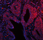 Immunofluorescent staining of FFPE human prostate cancer tissue with ARHGEF7 antibody (red) and DAPI nuclear stain (blue). HIER: steam section in pH8 EDTA buffer for 20 min.