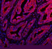 Immunofluorescent staining of FFPE human colon cancer tissue with ARHGEF7 antibody (red) and DAPI nuclear stain (blue). HIER: steam section in pH8 EDTA buffer for 20 min.