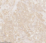 Immunohistochemical staining of ARHGEF7 using anti-ARHGEF7 antibody. ARHGEF7 was detected in a paraffin-embedded section of human lung adenocarcinoma tissue. Heat mediated antigen retrieval was performed in EDTA buffer (pH 8.0, epitope retrieval solution). The tissue section was blocked with 10% goat serum. The tissue section was then incubated with 2 ug/ml rabbit anti-ARHGEF7 antibody overnight at 4oC. Peroxidase Conjugated Goat Anti-rabbit IgG was used as secondary antibody and incubated for 30 minutes at 37oC. The tissue section was developed using an HRP secondary and DAB substrate.