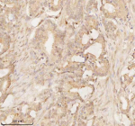 Immunohistochemical staining of ARHGEF7 using anti-ARHGEF7 antibody. ARHGEF7 was detected in a paraffin-embedded section of human prostate adenocarcinoma tissue. Heat mediated antigen retrieval was performed in EDTA buffer (pH 8.0, epitope retrieval solution). The tissue section was blocked with 10% goat serum. The tissue section was then incubated with 2 ug/ml rabbit anti-ARHGEF7 antibody overnight at 4oC. Peroxidase Conjugated Goat Anti-rabbit IgG was used as secondary antibody and incubated for 30 minutes at 37oC. The tissue section was developed using an HRP secondary and DAB substrate.
