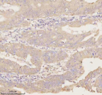 Immunohistochemical staining of ARHGEF7 using anti-ARHGEF7 antibody. ARHGEF7 was detected in a paraffin-embedded section of human rectum adenocarcinoma tissue. Heat mediated antigen retrieval was performed in EDTA buffer (pH 8.0, epitope retrieval solution). The tissue section was blocked with 10% goat serum. The tissue section was then incubated with 2 ug/ml rabbit anti-ARHGEF7 antibody overnight at 4oC. Peroxidase Conjugated Goat Anti-rabbit IgG was used as secondary antibody and incubated for 30 minutes at 37oC. The tissue section was developed using an HRP secondary and DAB substrate.