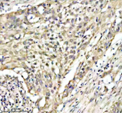 Immunohistochemical staining of PLAAT4 using anti-PLAAT4 antibody. PLAAT4 was detected in a paraffin-embedded section of human bladder cancer tissue. Heat mediated antigen retrieval was performed in EDTA buffer (pH 8.0, epitope retrieval solution). The tissue section was blocked with 10% goat serum. The tissue section was then incubated with 2 ug/ml rabbit anti-PLAAT4 antibody overnight at 4oC. Peroxidase Conjugated Goat Anti-rabbit IgG was used as secondary antibody and incubated for 30 minutes at 37oC. The tissue section was developed using an HRP secondary and DAB substrate.
