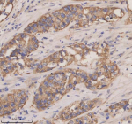 Immunohistochemical staining of CXCL13 using anti-CXCL13 antibody. CXCL13 was detected in a paraffin-embedded section of human appendiceal adenocarcinoma tissue. Heat mediated antigen retrieval was performed in EDTA buffer (pH 8.0, epitope retrieval solution). The tissue section was blocked with 10% goat serum. The tissue section was then incubated with 2 ug/ml rabbit anti-CXCL13 antibody overnight at 4oC. Peroxidase Conjugated Goat Anti-rabbit IgG was used as secondary antibody and incubated for 30 minutes at 37oC. The tissue section was developed using an HRP secondary and DAB substrate.