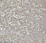 Immunohistochemical staining of MELTF using anti-MELTF antibody. MELTF was detected in a paraffin-embedded section of human melanoma cancer tissue. Heat mediated antigen retrieval was performed in EDTA buffer (pH 8.0, epitope retrieval solution). The tissue section was blocked with 10% goat serum. The tissue section was then incubated with 2 ug/ml rabbit anti-MELTF antibody overnight at 4oC. Peroxidase Conjugated Goat Anti-rabbit IgG was used as secondary antibody and incubated for 30 minutes at 37oC. The tissue section was developed using an HRP secondary and DAB substrate.