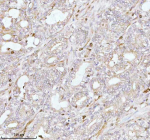 Immunohistochemical staining of PLBD2 using anti-PLBD2 antibody. PLBD2 was detected in a paraffin-embedded section of human prostate adenocarcinoma tissue. Heat mediated antigen retrieval was performed in EDTA buffer (pH 8.0, epitope retrieval solution). The tissue section was blocked with 10% goat serum. The tissue section was then incubated with 2 ug/ml rabbit anti-PLBD2 antibody overnight at 4oC. Peroxidase Conjugated Goat Anti-rabbit IgG was used as secondary antibody and incubated for 30 minutes at 37oC. The tissue section was developed using an HRP secondary and DAB substrate.