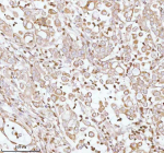 Immunohistochemical staining of PLBD2 using anti-PLBD2 antibody. PLBD2 was detected in a paraffin-embedded section of human lung adenocarcinoma tissue. Heat mediated antigen retrieval was performed in EDTA buffer (pH 8.0, epitope retrieval solution). The tissue section was blocked with 10% goat serum. The tissue section was then incubated with 2 ug/ml rabbit anti-PLBD2 antibody overnight at 4oC. Peroxidase Conjugated Goat Anti-rabbit IgG was used as secondary antibody and incubated for 30 minutes at 37oC. The tissue section was developed using an HRP secondary and DAB substrate.