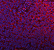 Immunofluorescent staining of FFPE human lung cancer tissue with PLBD2 antibody (red) and DAPI nuclear stain (blue). HIER: steam section in pH8 EDTA buffer for 20 min.